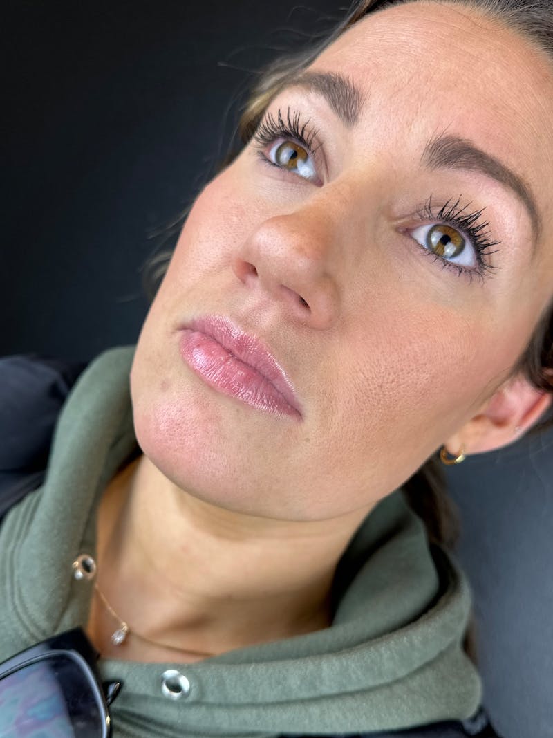 Lip Filler Before & After Gallery - Patient 953424 - Image 1