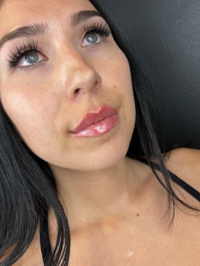 Lip Filler Before & After Gallery - Patient 333938 - Image 2