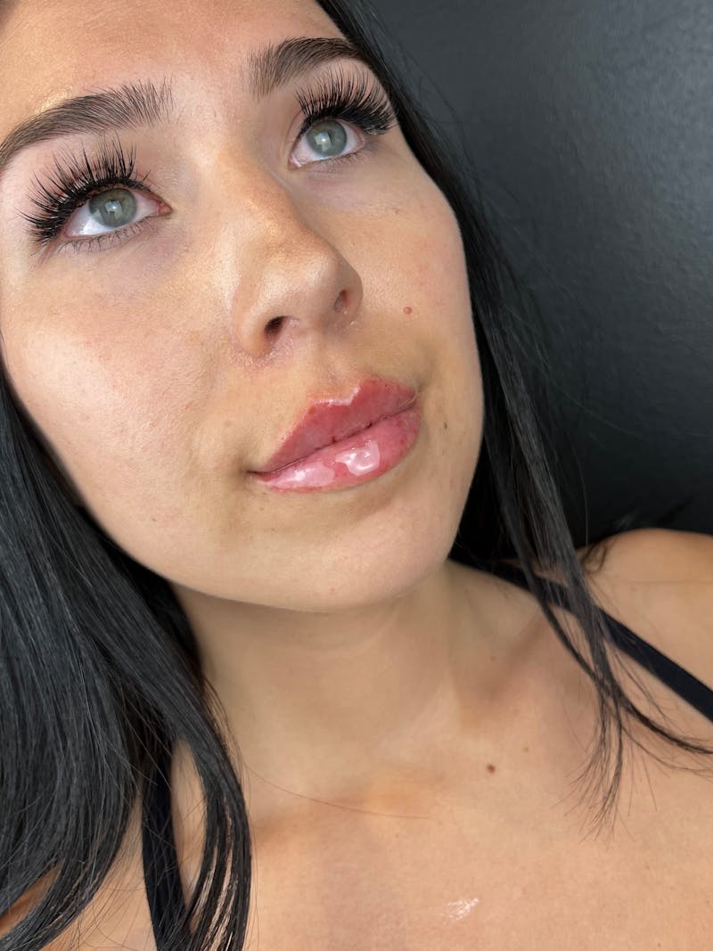 Lip Filler Before & After Gallery - Patient 333938 - Image 2