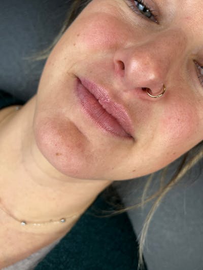 Lip Filler Before & After Gallery - Patient 174751 - Image 1