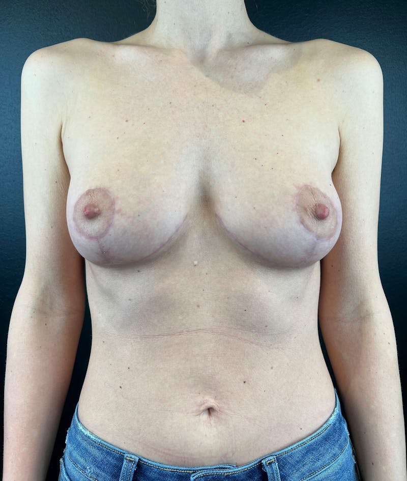 Breast Lift Before & After Gallery - Patient 245523 - Image 2