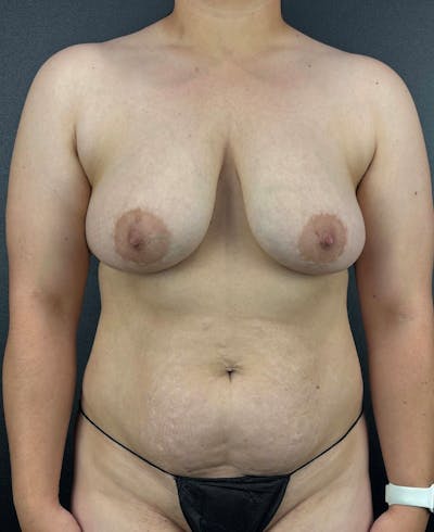 Breast Aug-Pexy Before & After Gallery - Patient 491617 - Image 1