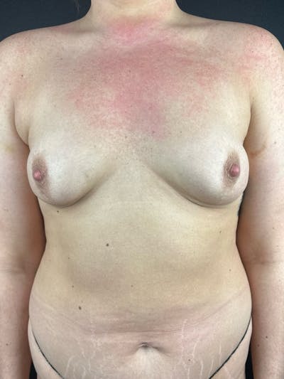 Breast Augmentation Before & After Gallery - Patient 347566 - Image 1