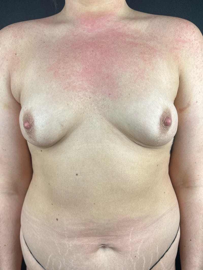 Breast Augmentation Before & After Gallery - Patient 347566 - Image 1