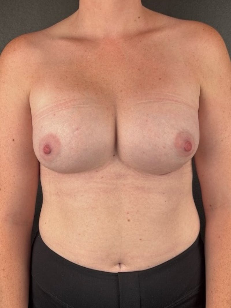 Breast Augmentation Before & After Gallery - Patient 115171 - Image 2