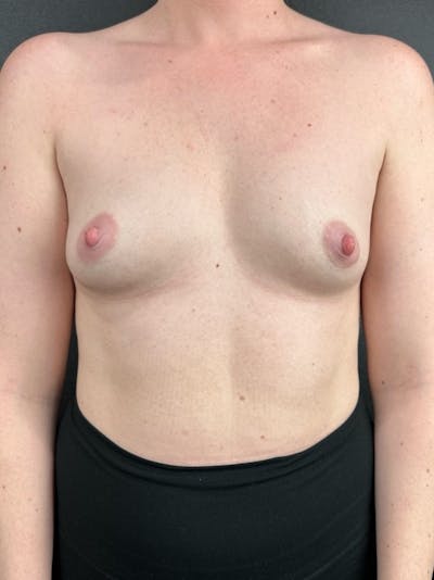 Breast Augmentation Before & After Gallery - Patient 115171 - Image 1