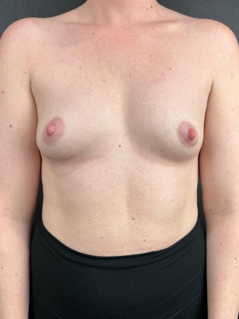 Breast Augmentation Before & After Gallery - Patient 115171 - Image 1