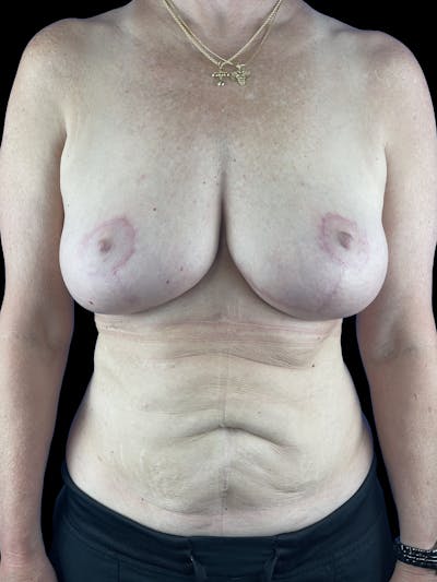 Breast Lift w/Fat Grafting Before & After Gallery - Patient 111690 - Image 2