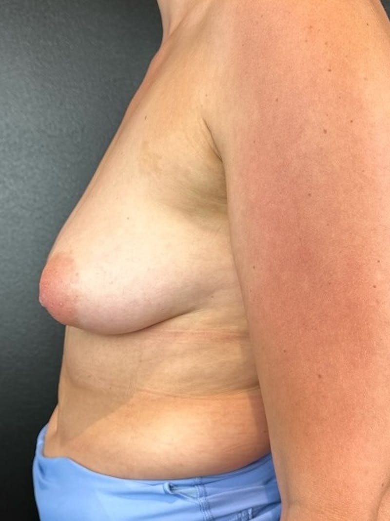 Breast Aug-Pexy Before & After Gallery - Patient 451220 - Image 3