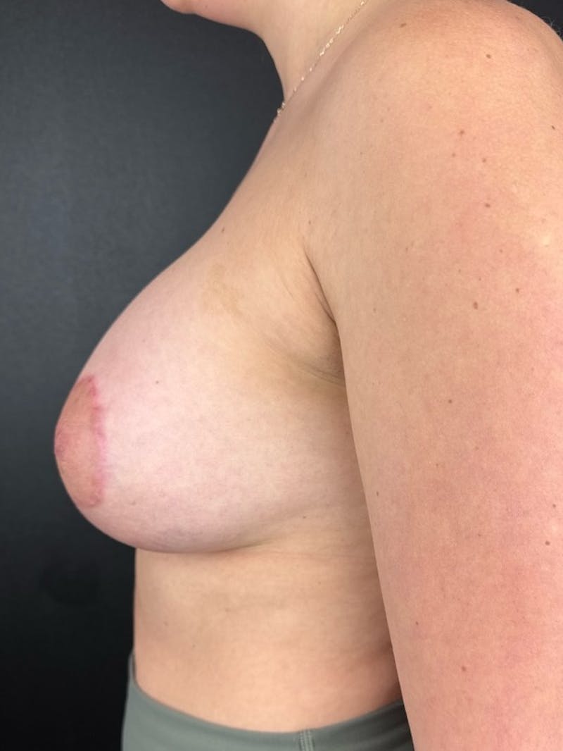 Breast Aug-Pexy Before & After Gallery - Patient 451220 - Image 4