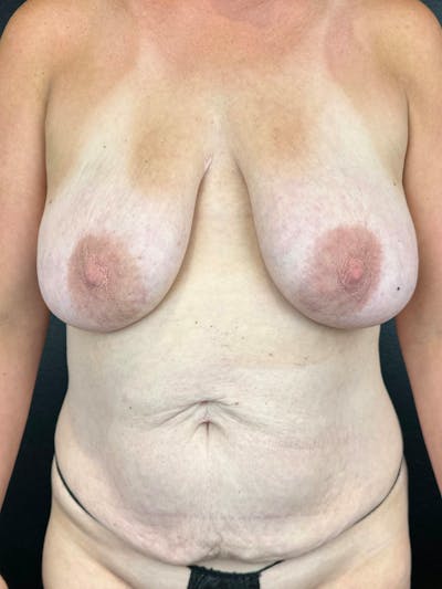 Breast Aug-Pexy Before & After Gallery - Patient 145079 - Image 1