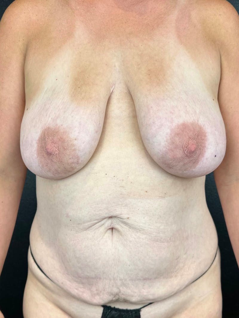 Breast Aug-Pexy Before & After Gallery - Patient 145079 - Image 1