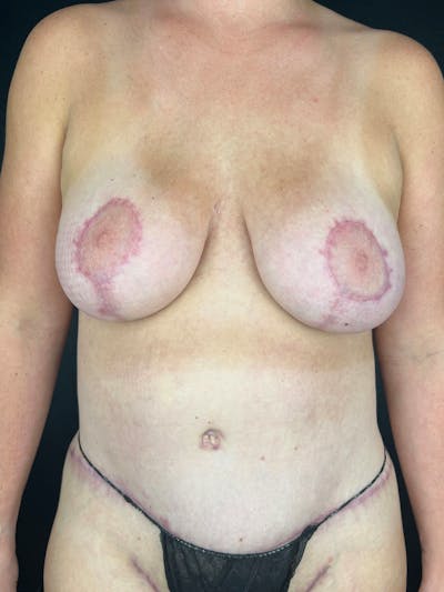 Breast Aug-Pexy Before & After Gallery - Patient 145079 - Image 2