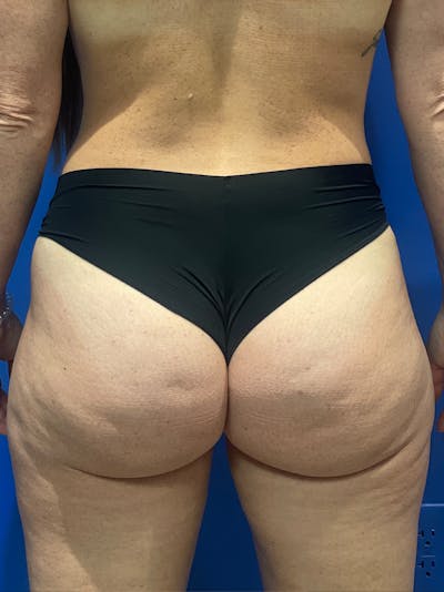 BBL + Aveli  Before & After Gallery - Patient 111360 - Image 1