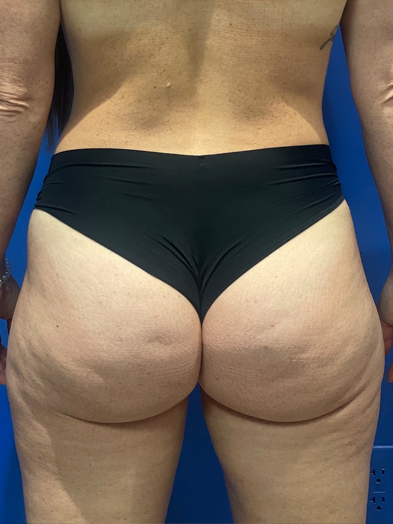 BBL + Aveli  Before & After Gallery - Patient 111360 - Image 1