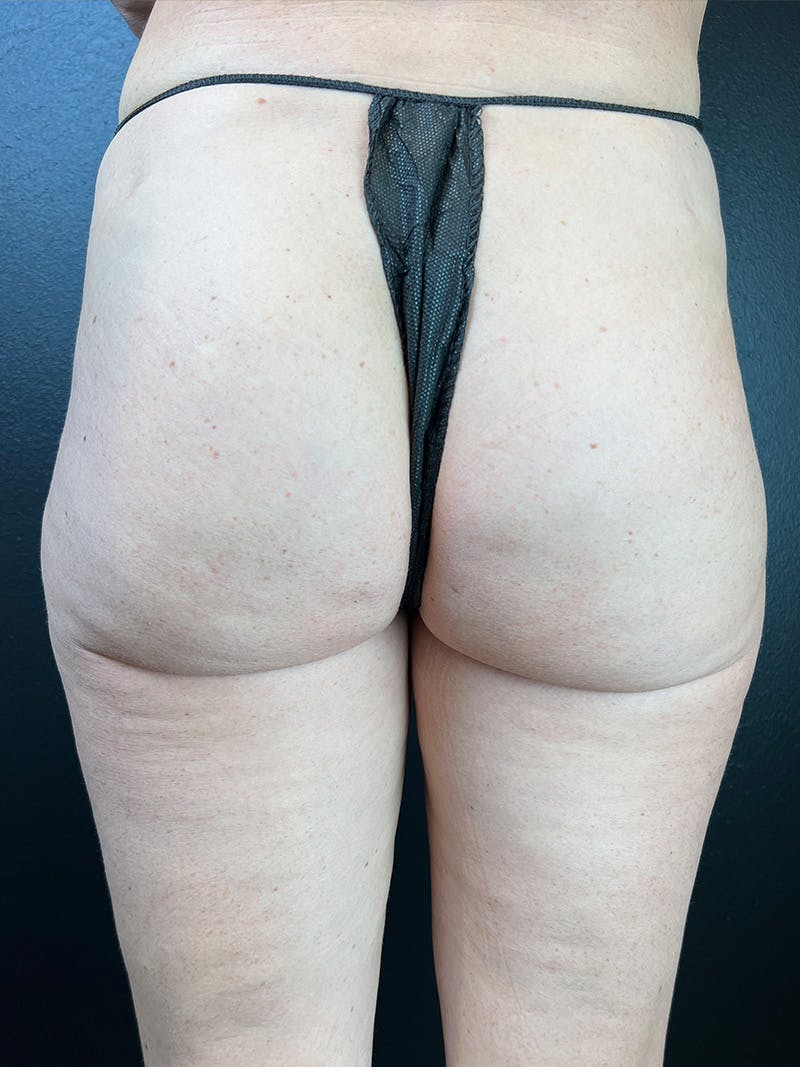 BBL + Aveli  Before & After Gallery - Patient 111360 - Image 2
