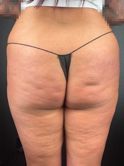 BBL + Aveli  Before & After Gallery - Patient 249237 - Image 1