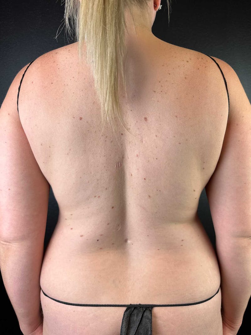 Back (Liposuction) Before & After Gallery - Patient 677416 - Image 1
