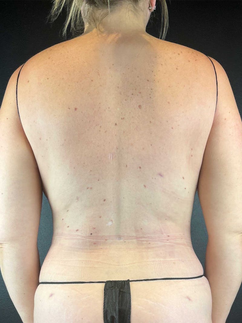 Back (Liposuction) Before & After Gallery - Patient 677416 - Image 2