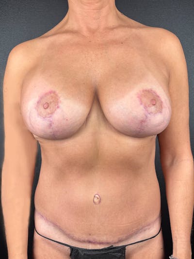 Mommy Makeover Before & After Gallery - Patient 204323 - Image 2