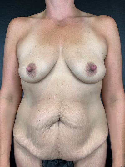 Mommy Makeover Before & After Gallery - Patient 301990 - Image 1