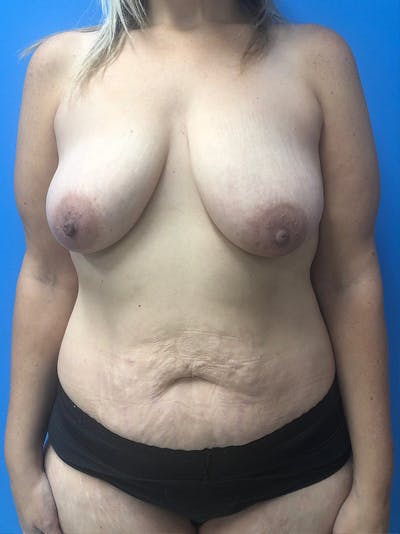 Mommy Makeover Before & After Gallery - Patient 296182 - Image 1