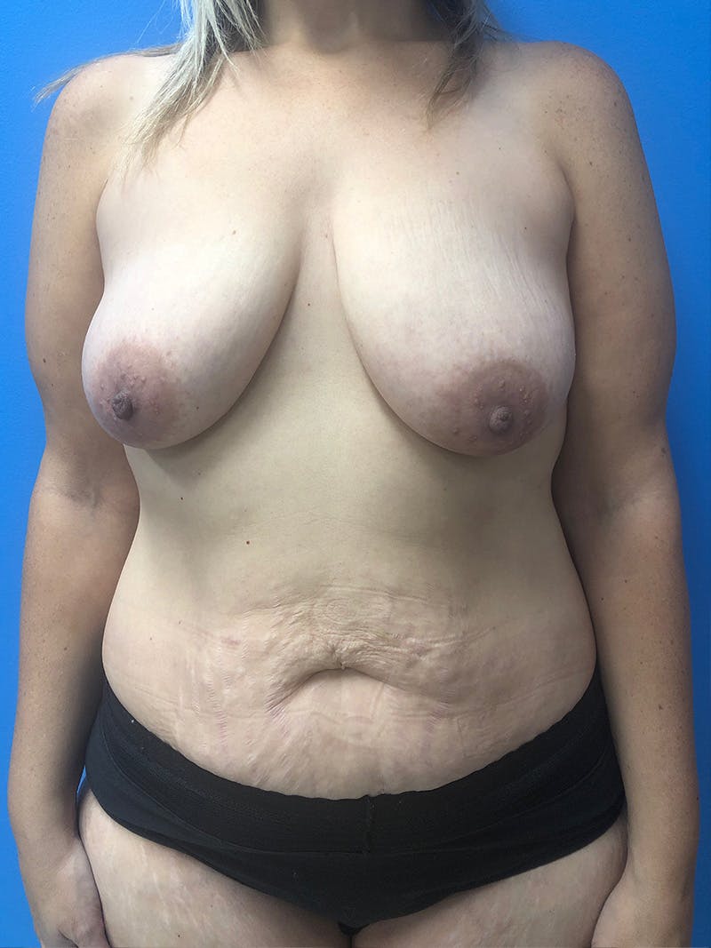 Mommy Makeover Before & After Gallery - Patient 296182 - Image 1