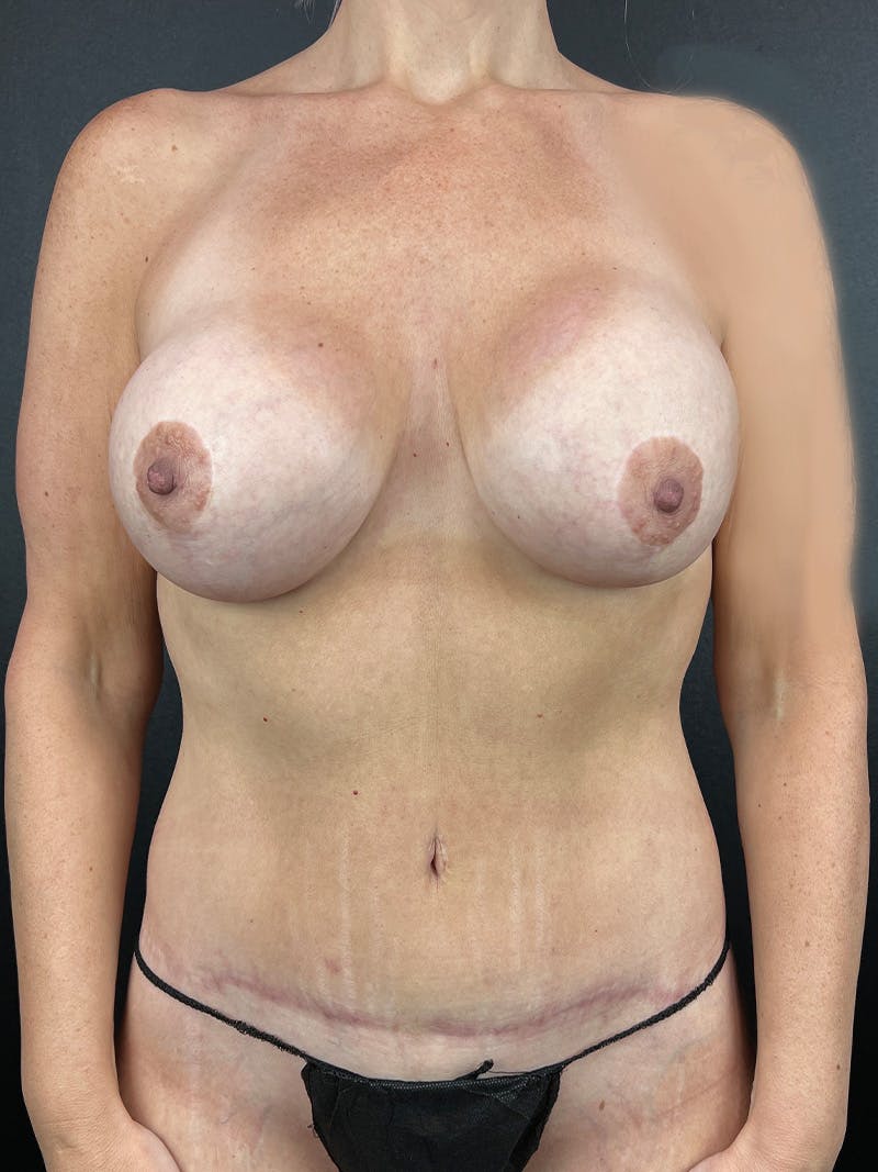 Mommy Makeover Before & After Gallery - Patient 296182 - Image 2