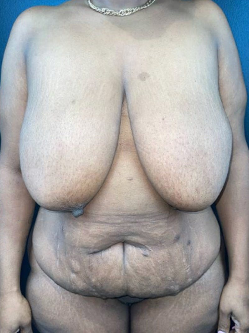 Mommy Makeover Before & After Gallery - Patient 102461 - Image 1