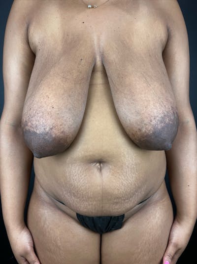 Mommy Makeover Before & After Gallery - Patient 414667 - Image 1