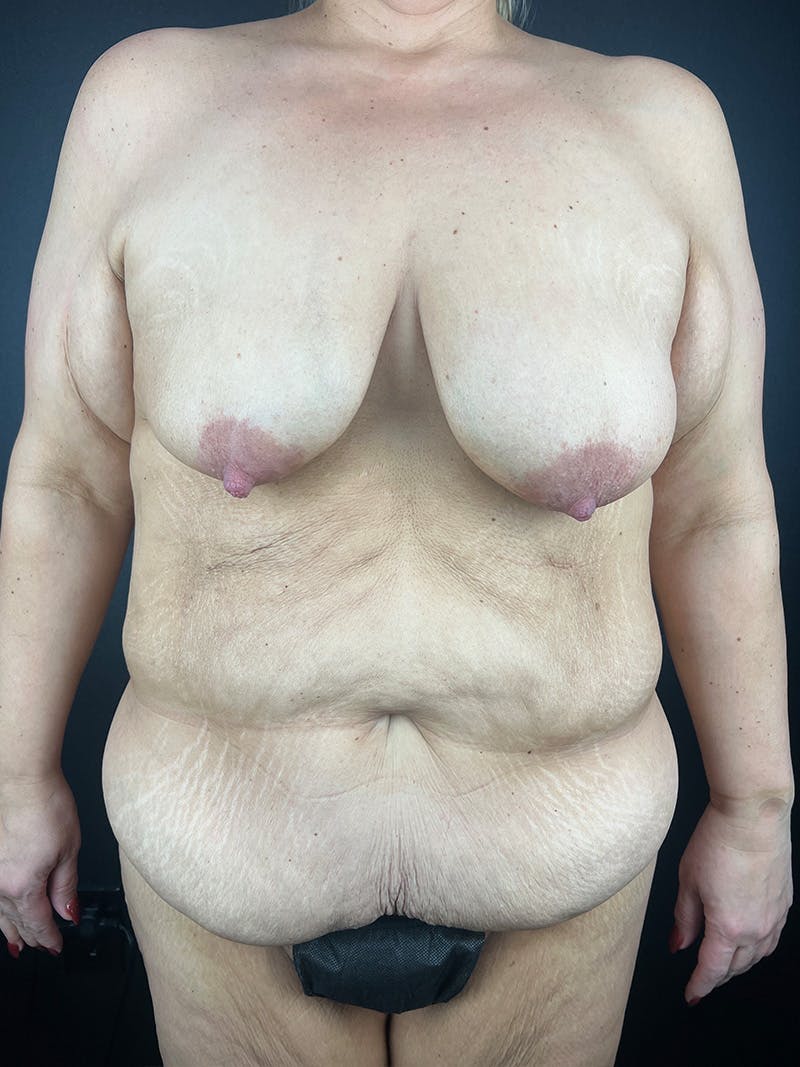 Mommy Makeover Before & After Gallery - Patient 125646 - Image 1