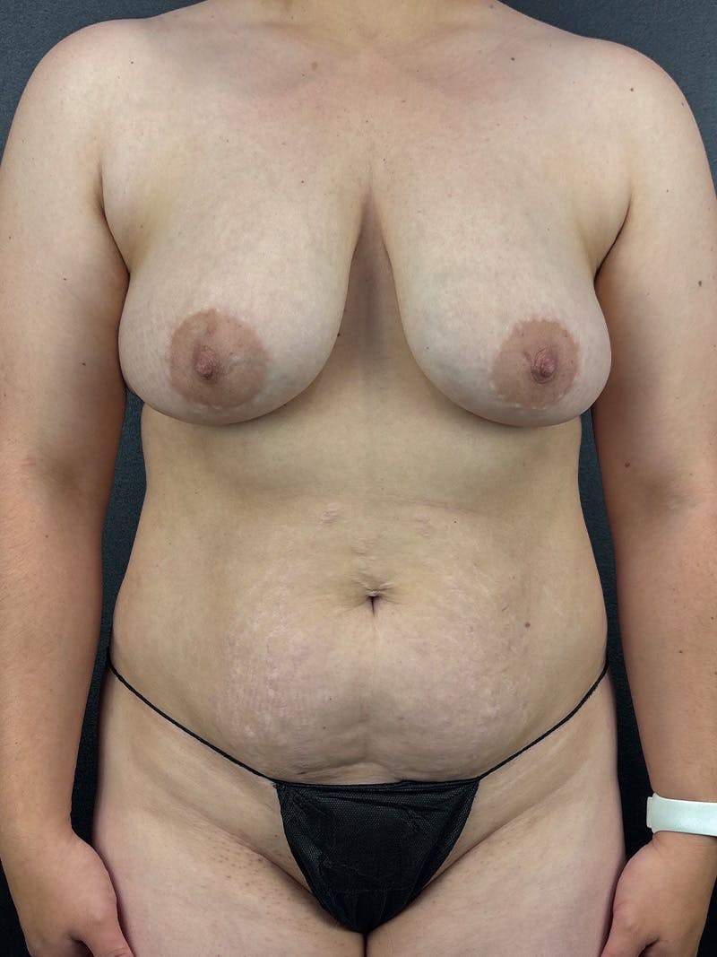 Mommy Makeover Before & After Gallery - Patient 709657 - Image 1