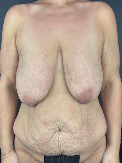 Mommy Makeover Before & After Gallery - Patient 368441 - Image 1