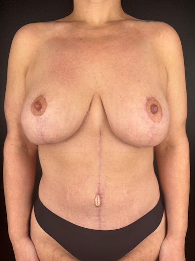 Mommy Makeover Before & After Gallery - Patient 368441 - Image 2