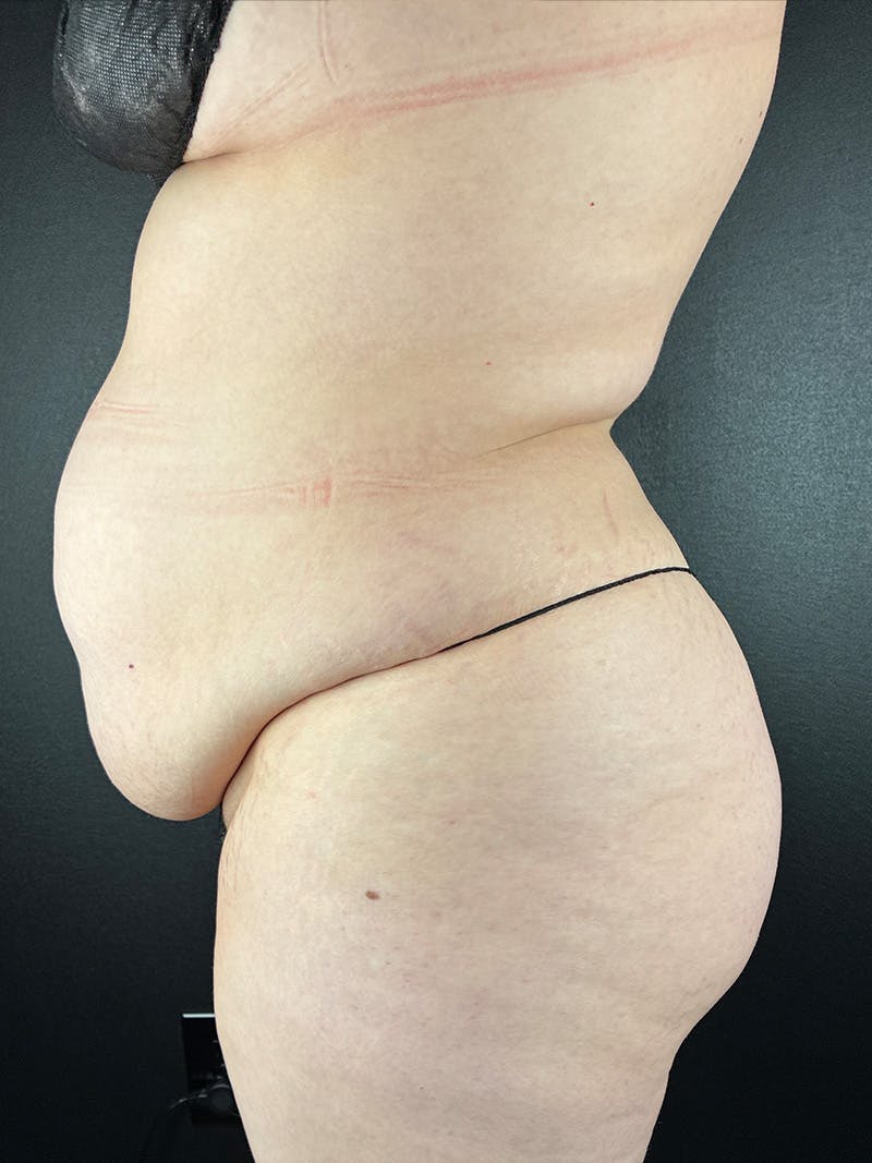 Mommy Makeover Before & After Gallery - Patient 344832 - Image 1