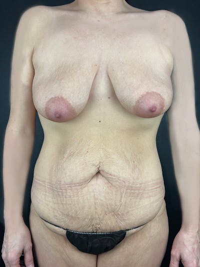 Mommy Makeover Before & After Gallery - Patient 422887 - Image 1