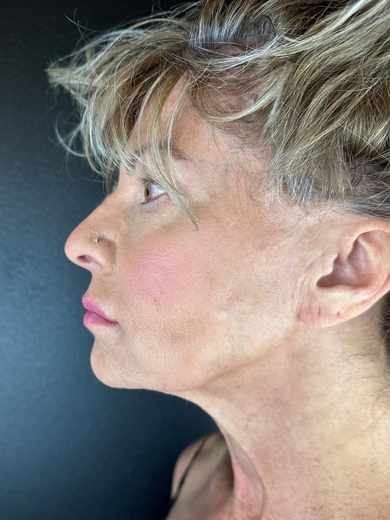 Neck Lift Before & After Gallery - Patient 335566 - Image 1
