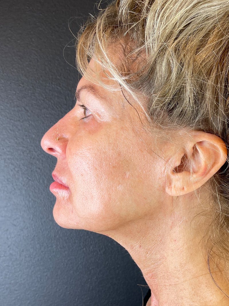 Neck Lift Before & After Gallery - Patient 335566 - Image 2