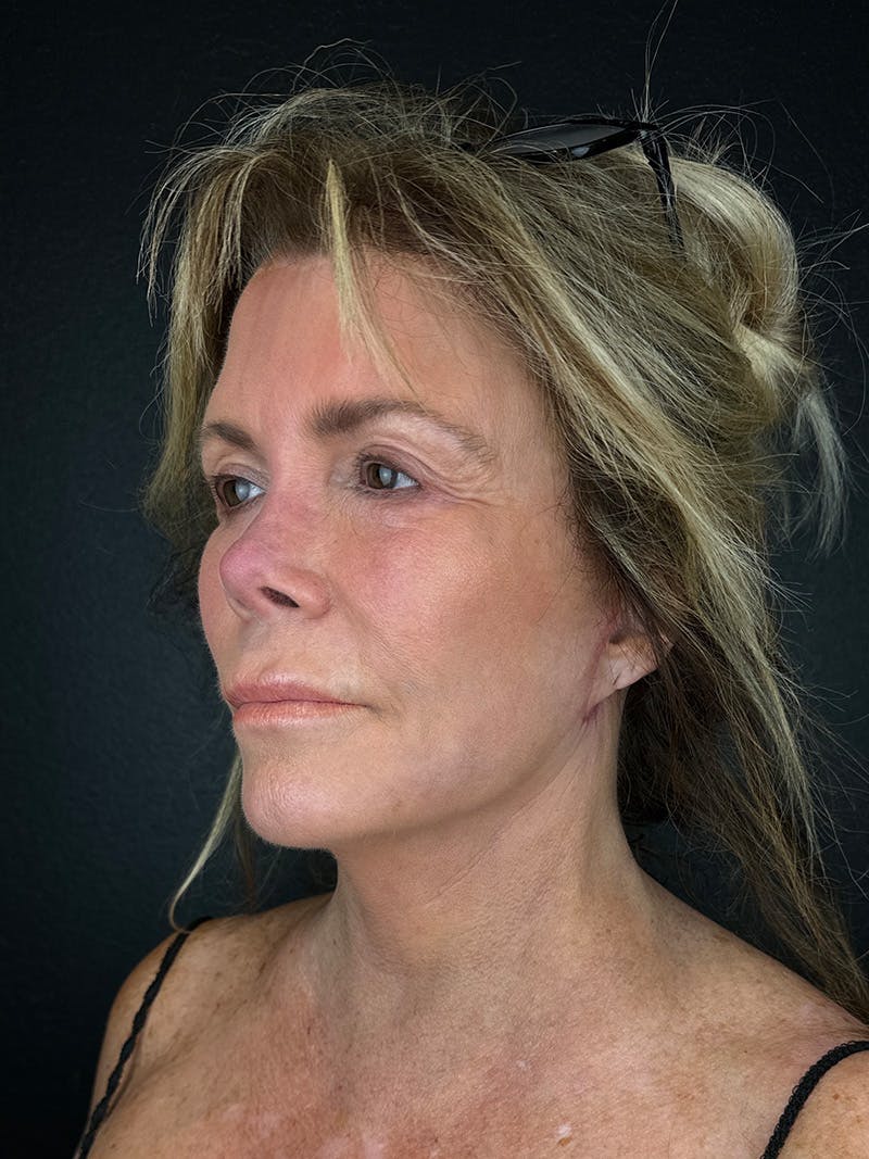 Neck Lift Before & After Gallery - Patient 335566 - Image 4