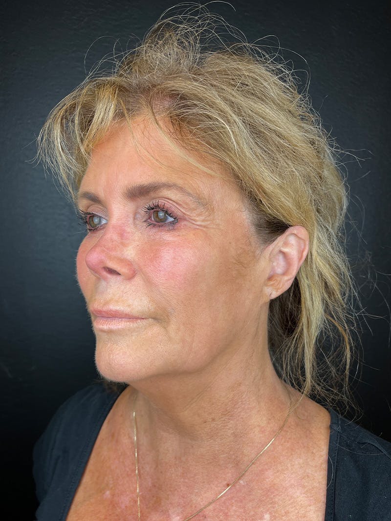 Neck Lift Before & After Gallery - Patient 335566 - Image 3