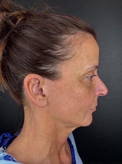 Neck Lift Before & After Gallery - Patient 330903 - Image 1