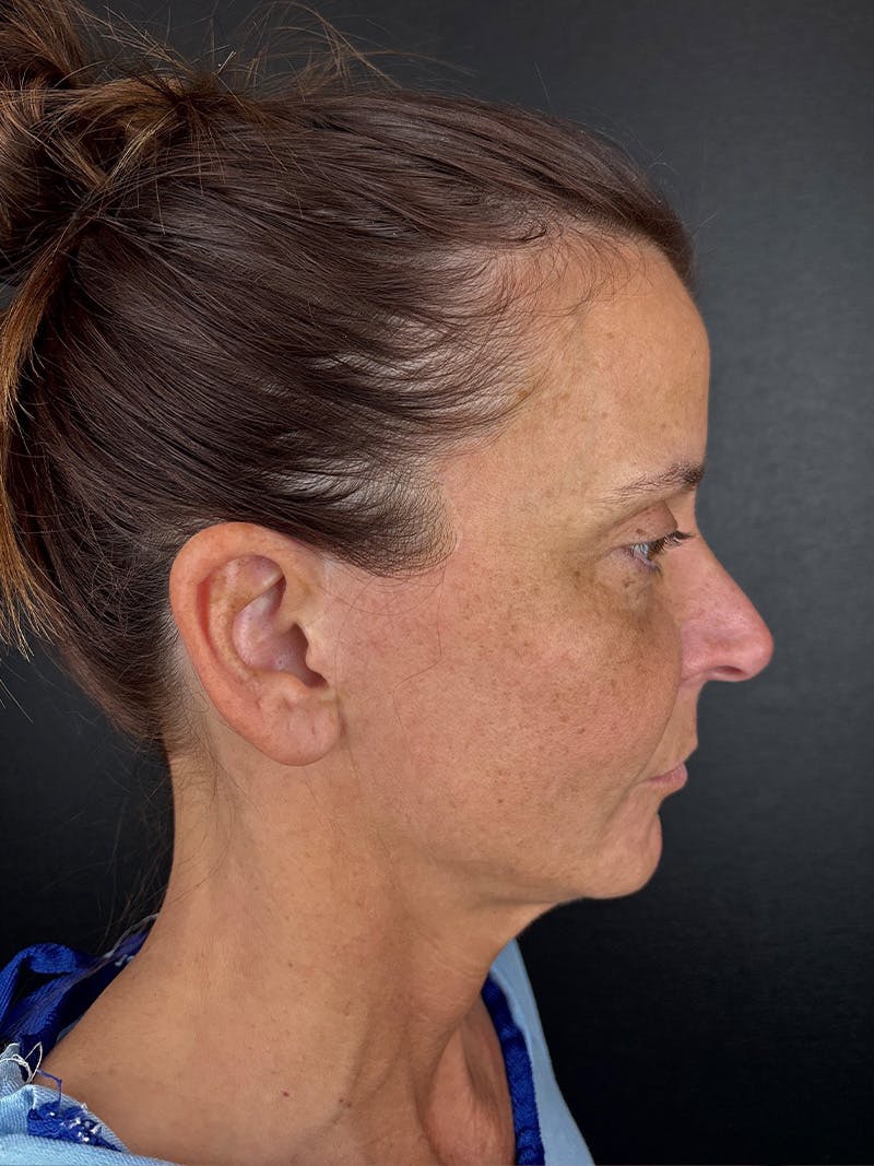 Facelift Before & After Gallery - Patient 153323 - Image 1
