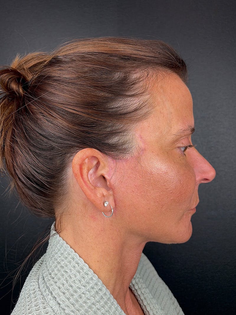 Facelift Before & After Gallery - Patient 153323 - Image 2