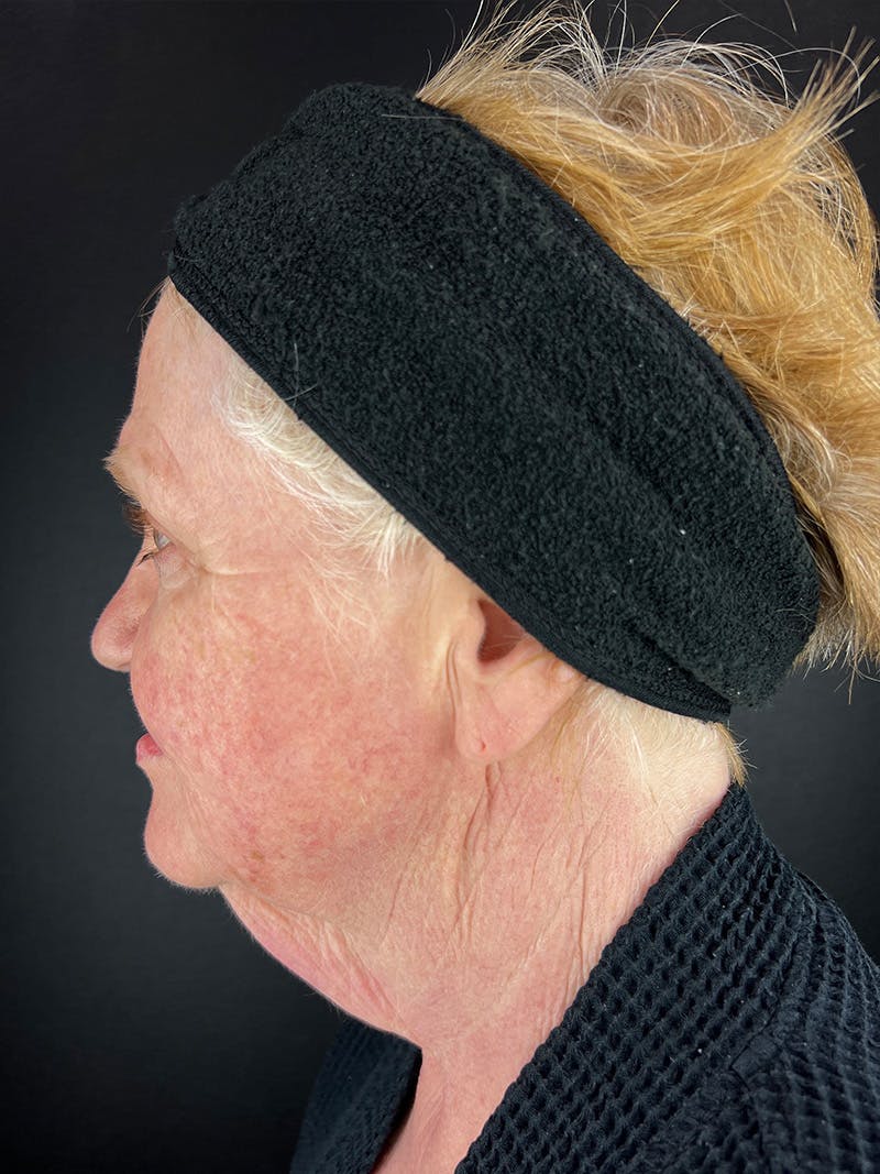 Facelift Before & After Gallery - Patient 411487 - Image 1