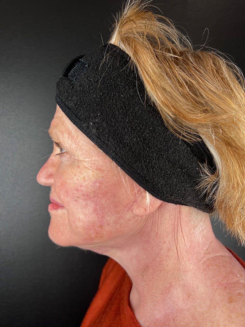 Facelift Before & After Gallery - Patient 411487 - Image 2