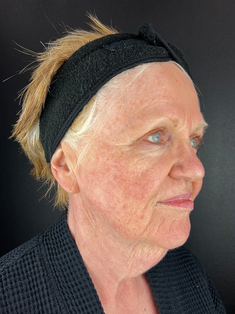 Facelift Before & After Gallery - Patient 411487 - Image 3
