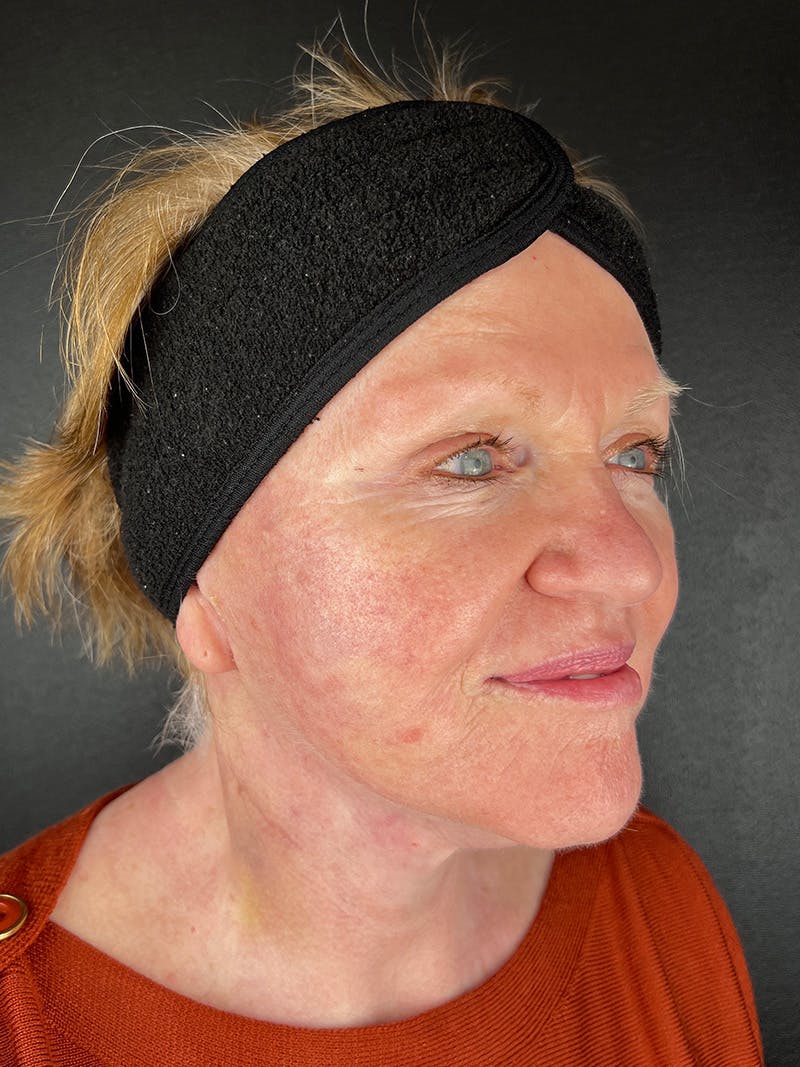 Facelift Before & After Gallery - Patient 411487 - Image 4