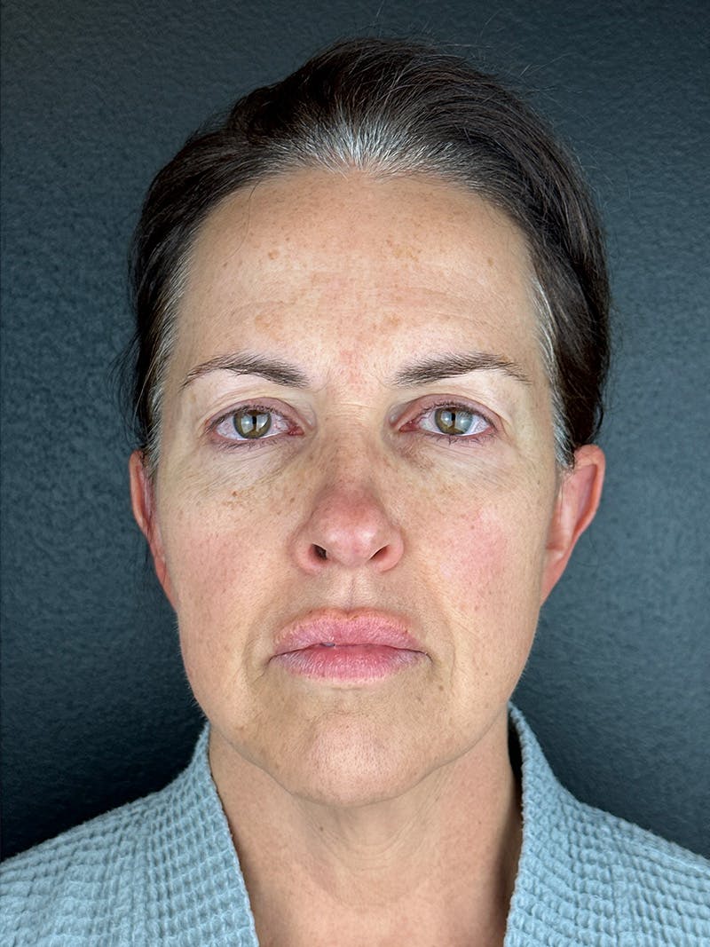 Panfacial Fat Grafting Before & After Gallery - Patient 282148 - Image 1