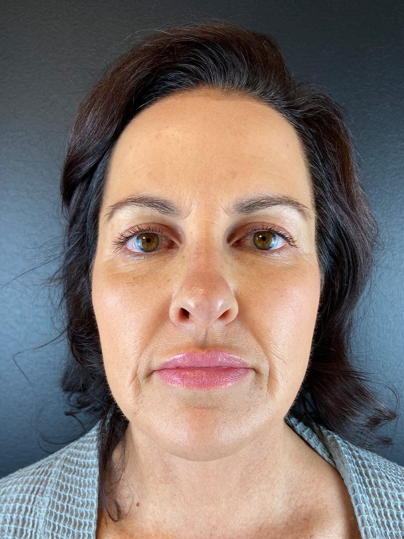 Panfacial Fat Grafting Before & After Gallery - Patient 282148 - Image 2