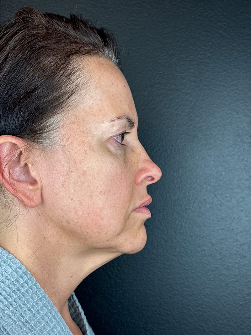 Panfacial Fat Grafting Before & After Gallery - Patient 282148 - Image 3